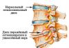 Почему происходит защемление нерва в спине и как с этим бороться?